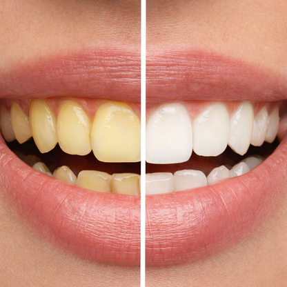 Teeth Whitening Strips By Dropavia – Visible Results in 30 Minutes